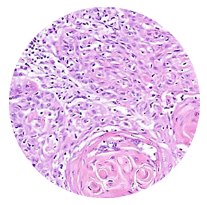 squamous-cell