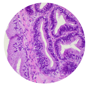 adenocarcinoma