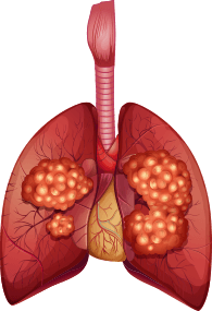 carcinoma