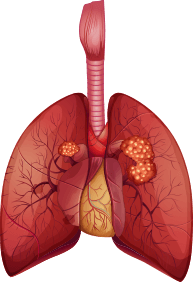 squamous